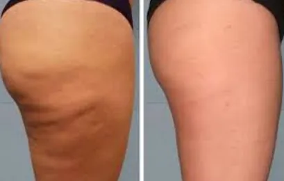 Natural Cellulite Removal Cream Glaze For Tightening And Detoxing Skin